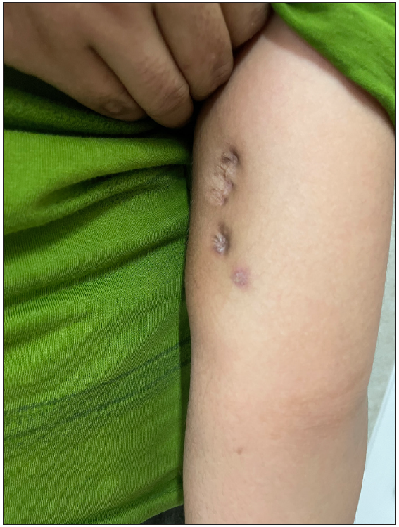 Healed lesions with scar.